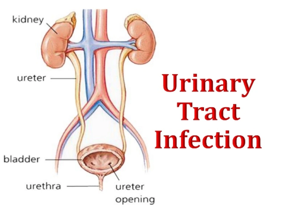 The relationship between urinary tract infections and spasms