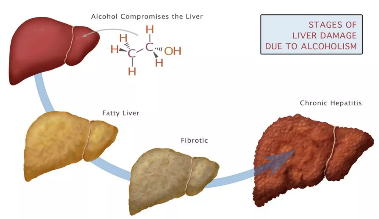 The role of disulfiram in treating alcohol-induced liver disease